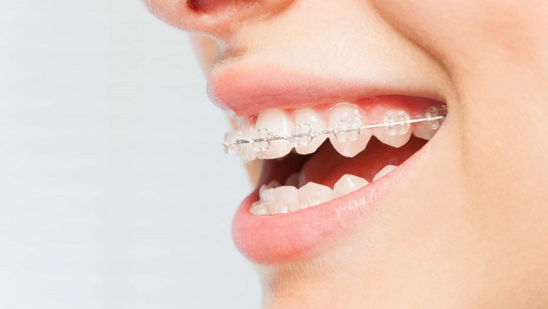 With Orthodontic Supplies, Teeth Gradually Move And Jaw Alignment Gradually Changes Over Time