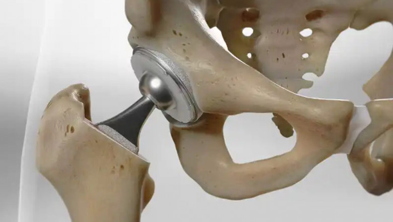 Hip Replacement Surgery Cost in Delhi