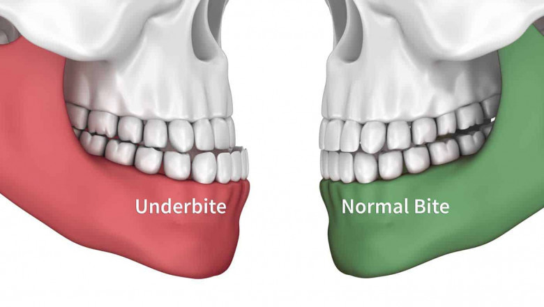 What's the Best Age To Get Braces?