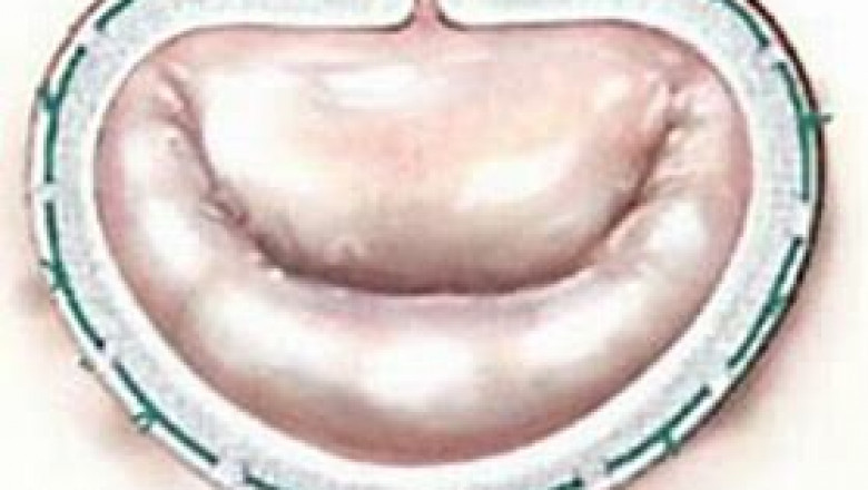 Annuloplasty Rings Market Analysis, Size, Share, Growth and Trends Report To 2028