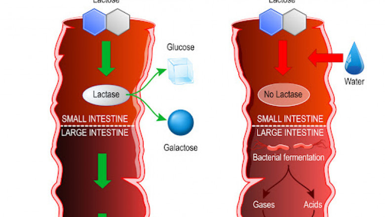 Lactose Intolerance: Causes, Symptoms And Remedies