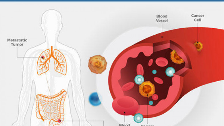 Cancer Protection is About Making Smart Decisions