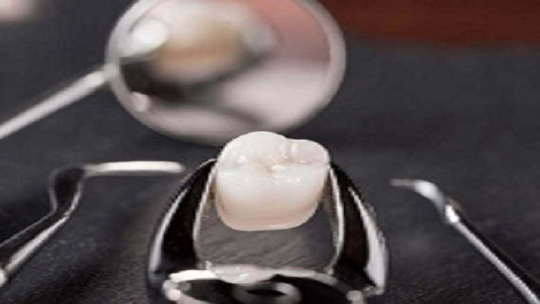 What Are Snap-on Smiles?