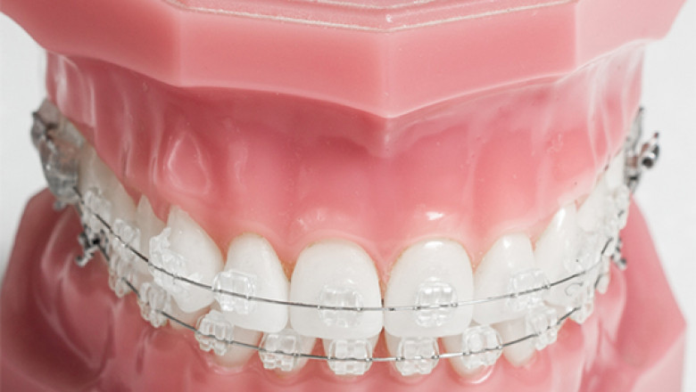How to know about the braces are effective for crooked teeth in South Jersey?