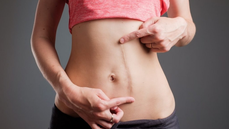 Scar revision surgery: procedure improves appearance of marks