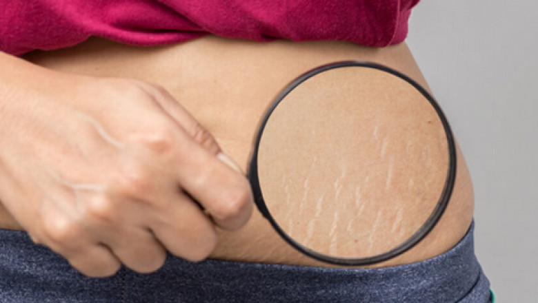 Stretch Marks Removal in Delhi, India • Check Prices & Reviews