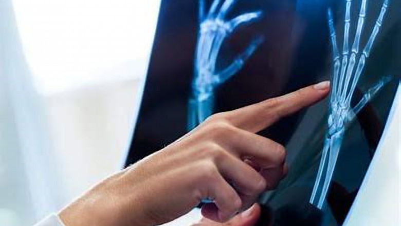 Rheumatoid Arthritis Diagnostic Tests Market 2022: Industry Trends, Growth Analysis And Forecast To 2028