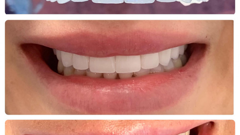 What Does The Deep Cleaning Procedure Include?