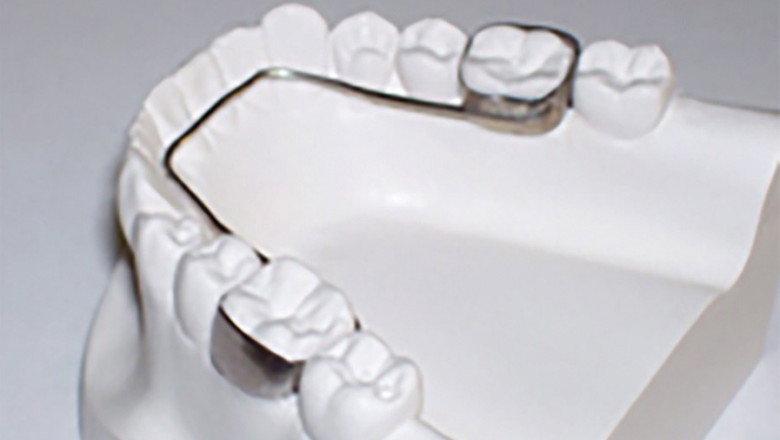 What Are The Important Things To Know Regarding Lingual Braces?