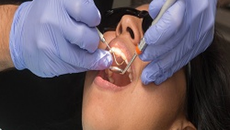 Why Should You Choose a Dental Bridge?