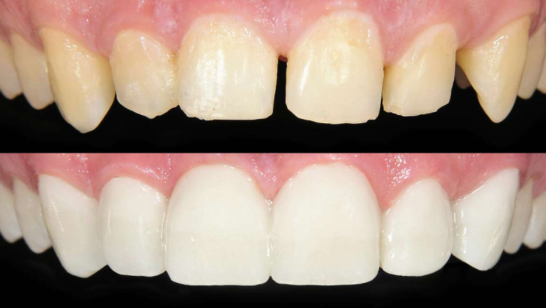 What Exactly Is A Dental Bonding Procedure?