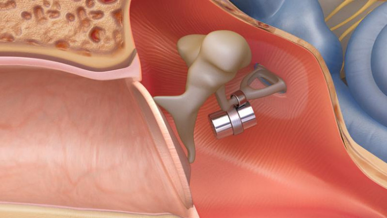 What are the Middle Ear Implants?