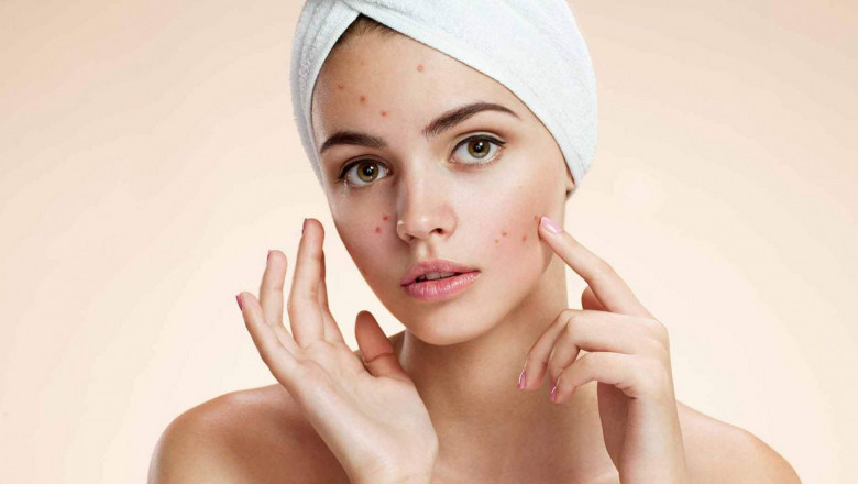 Increasing Prevalence of Global Acne Vulgaris Treatment Market, Forecast Analysis 2022-2028