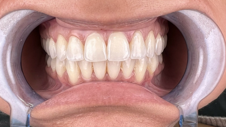 What Are The Important Factors Behind Denture Prices?