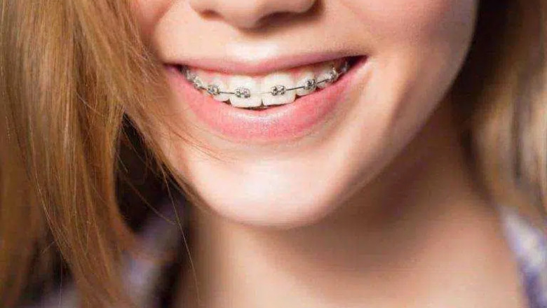 What Is Orthodontic Treatment? | Tower House Dental Clinic