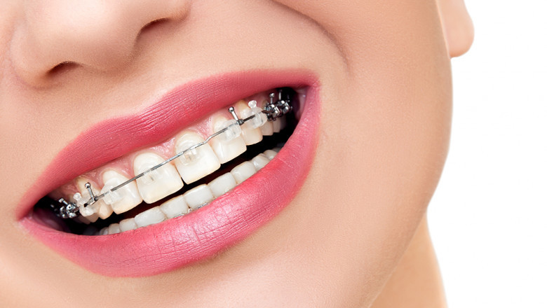 What Are Braces?