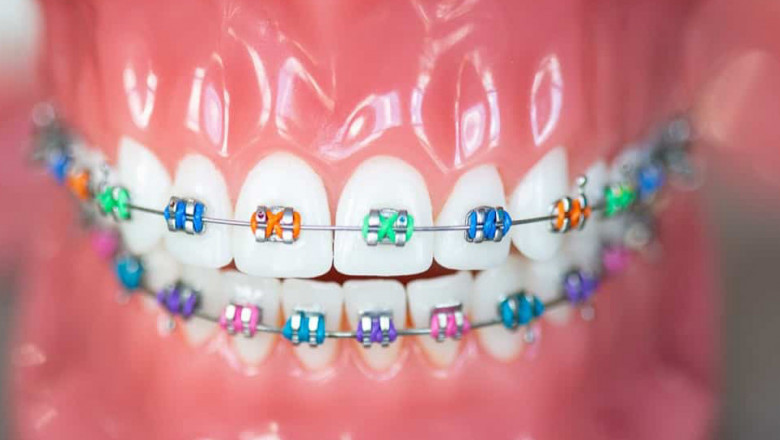 How To Know Which Braces Color Is Best For You?