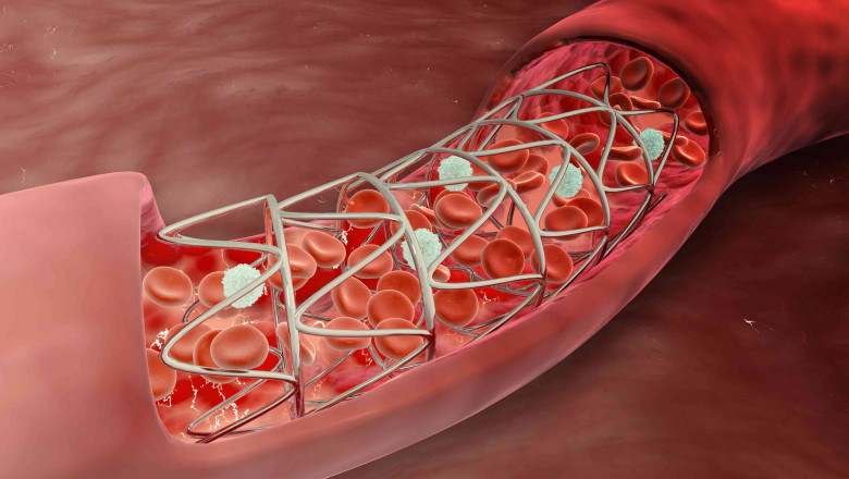 Thrombectomy Devices Market Research Report - Competitive Analysis and Forecast period during 2022-2027
