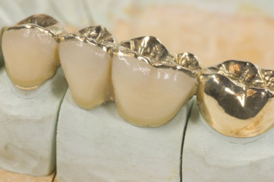 Dental Inlays and Onlays Market 2022 Size, Growth Factors & Forecast Report to 2028
