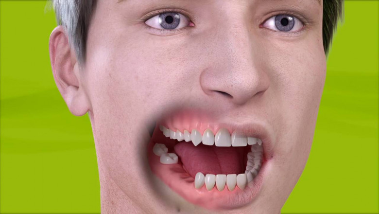 What Can I Have Instead of a Dental Implant?
