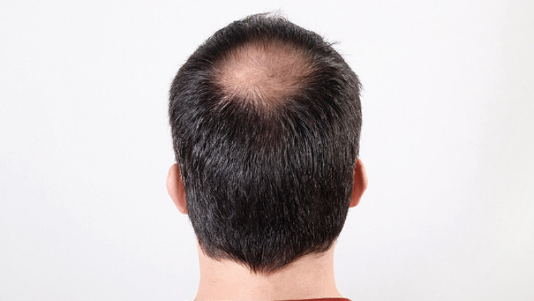 Platelet-Rich Plasma (PRP) Injections