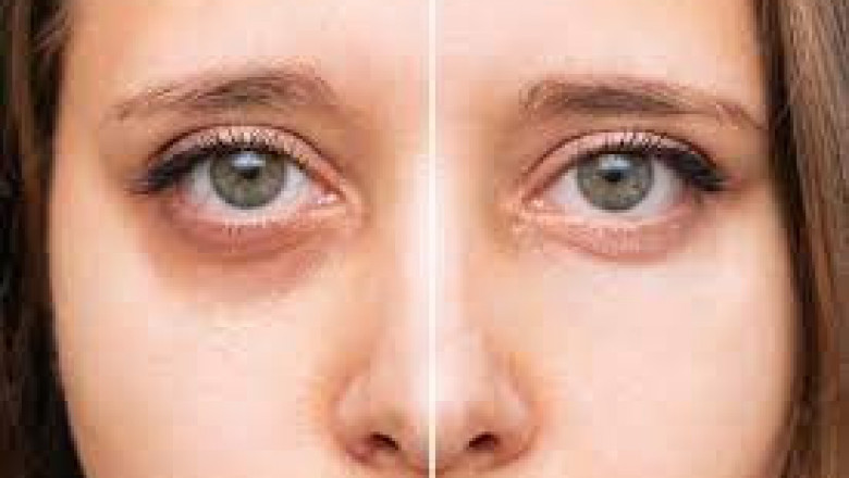 Dark Under Eyes Treatment San Diego