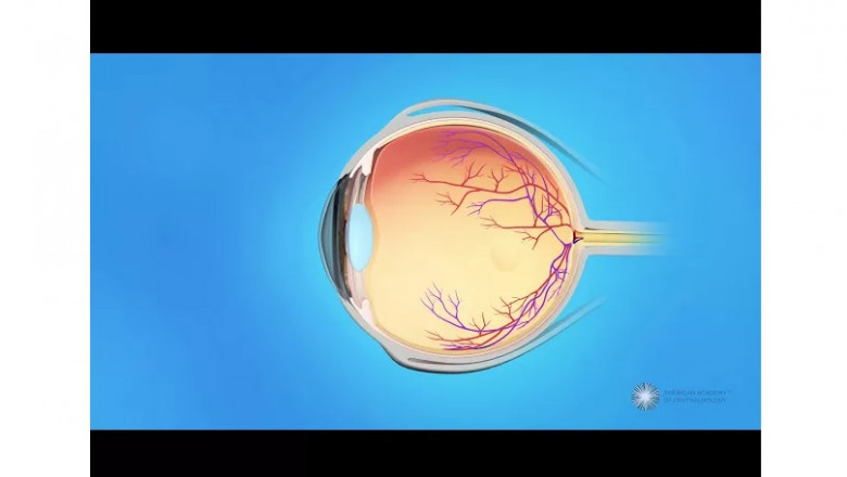 Consider what a specialist in eyes has to say