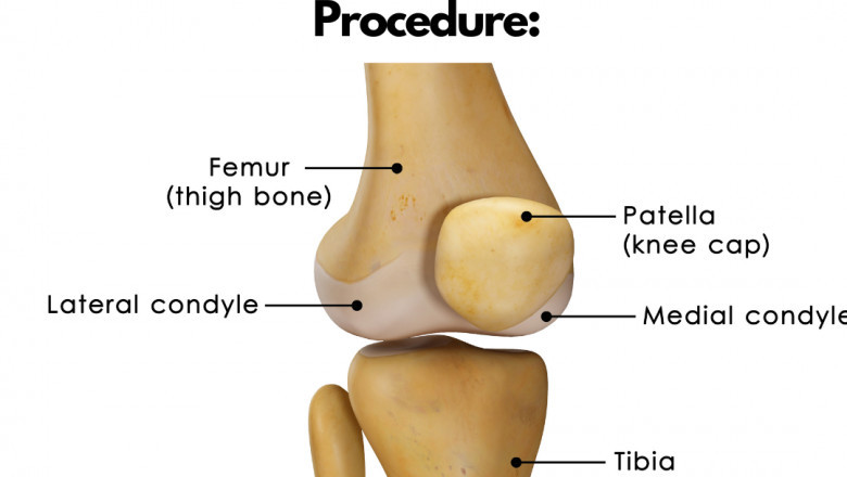 Guide to the Knee Replacement Procedure: What to Expect, Recovery Time, and More