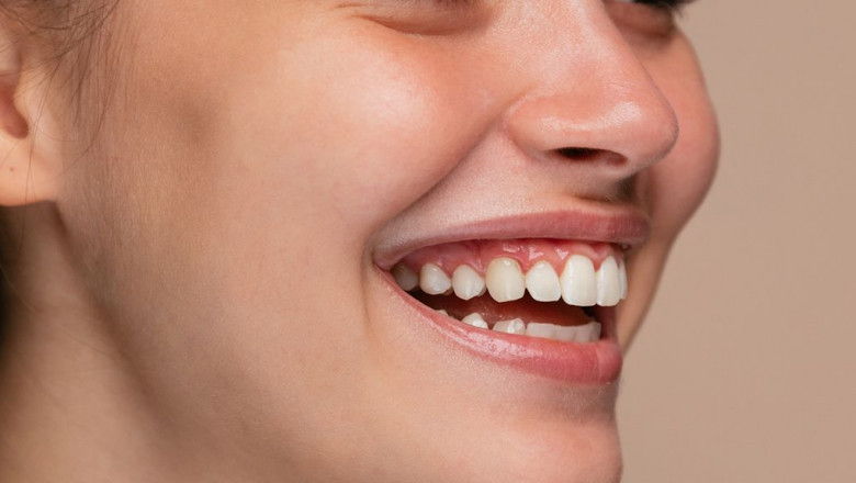 Why Go For Dental Bonding?