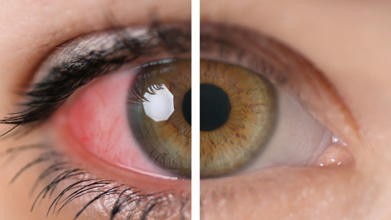 Uveitis Treatment Market Emerging Trend, Top Companies, Company Demand, Business Review And Regional Analysis By 2026