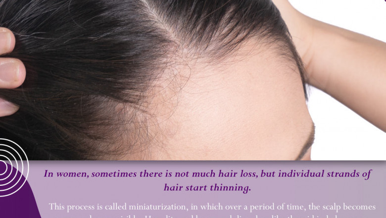 What Are the Treatment Options Available for Women’s Hair Loss