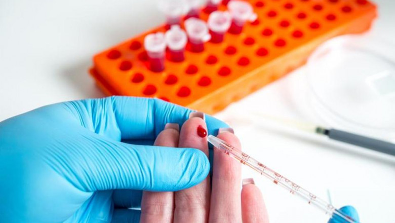 The Microscopic Evaluation of Blood Using Blood Films has been the Cornerstone of Malaria Diagnostics