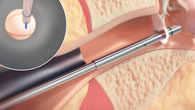 Tympanostomy Products Products Are Intended To Aid In The Removal Of Earwax