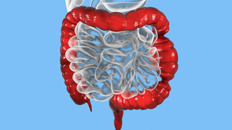 What is Short Bowel Syndrome?