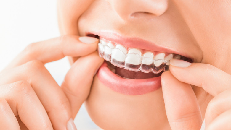 Does Metlife Cover Invisalign?