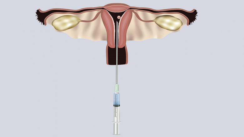 By Using Assistive Reproductive Technology,Infertility Issues Can Be Resolved While Maintaining Genetic Ties