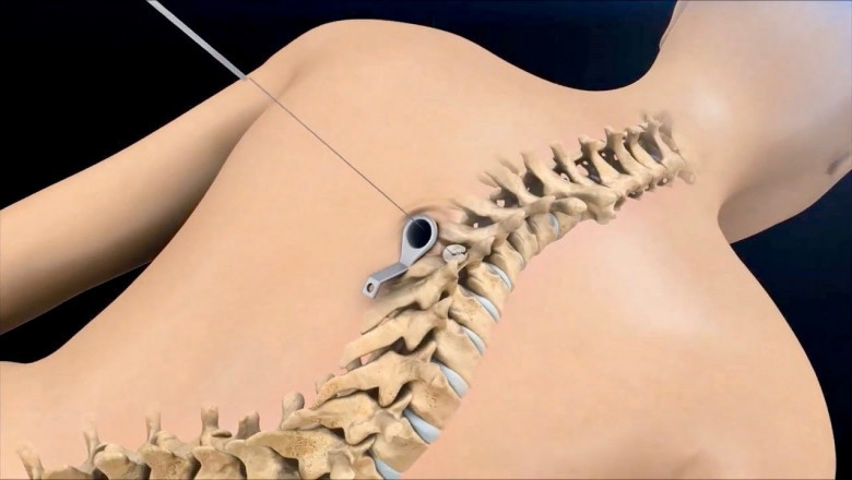 It Is Possible To Stabilize, Deform, And Strengthen The Spine By Using Spinal Non-Fusion Devices