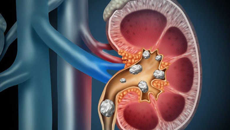 Urolithiasis Management Devices are fiberoptic endoscopes used in minimally invasive procedures for removing kidney stones.