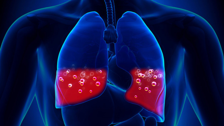 What is Pulmonary Edema Therapeutics