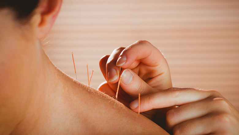 Acupuncture For Pain Relief