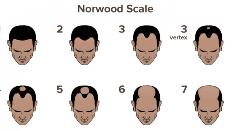Best Hair Transplant Surgery in Bangalore | Hair Transplant
