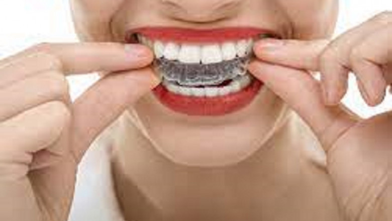 Invisible Orthodontics Market Size, Key Players Analysis And Forecast To 2028