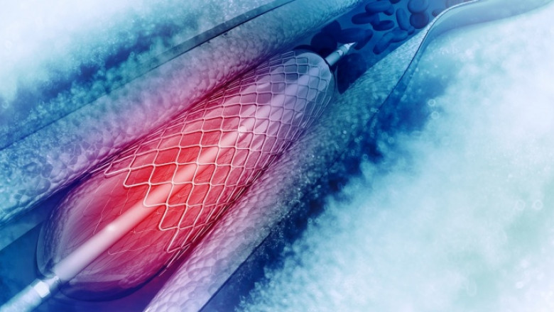 Angioplasty Balloons Opens Narrow, Blocked Arteries Using Minimally Invasive Cardiac Catheterization