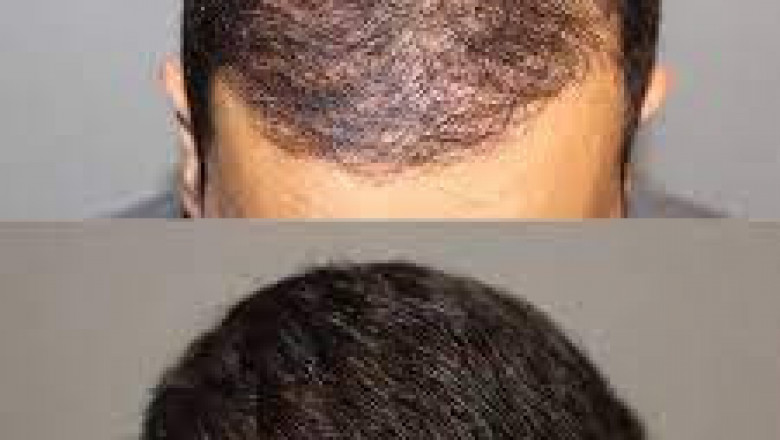 Prp Therapy For Hair Loss Treatment San Diego