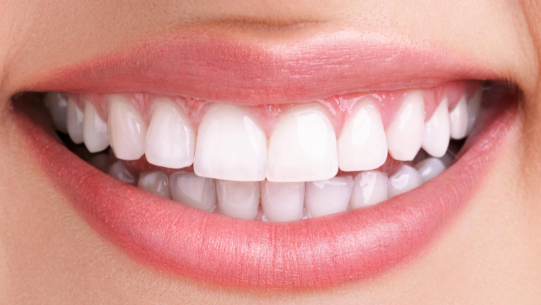 What Are the Things You Need to Know About Composite Veneers?