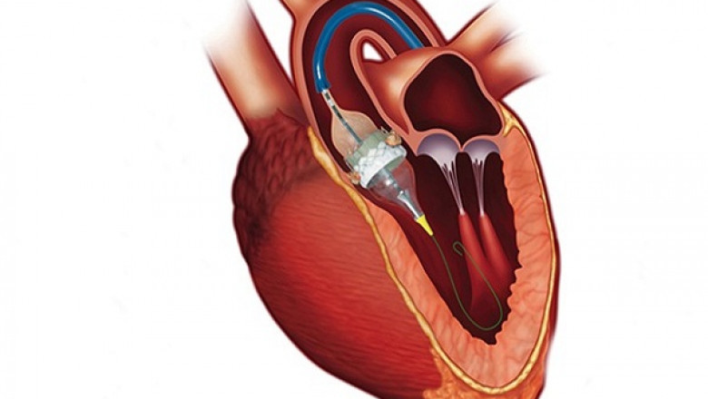 Transcatheter Aortic Valve Implantation (TAVI) Market Proliferating Opportunities, New Innovation, Development, Application Till 2025