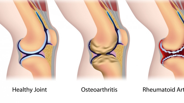 Best knee arthroscopy surgery in Delhi