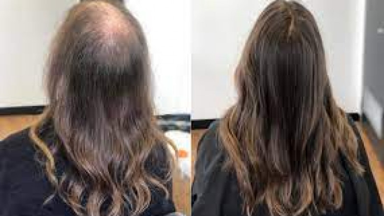 Hair loss treatment Queen Street East Toronto